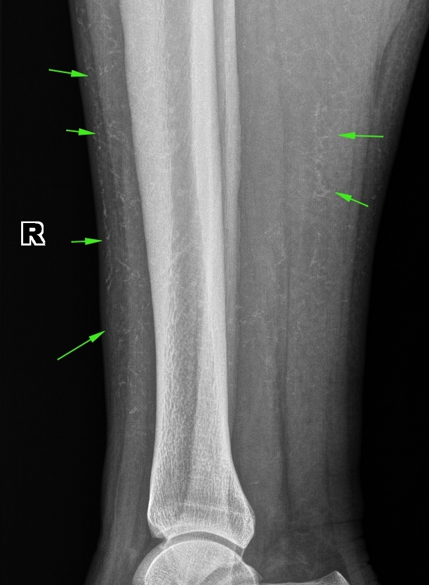 Фото берцовой кости. Рентген большеберцовой кости норма. Атеросклероз сосудов голени рентген. Обызвествление сосудов голени на рентгене. Обызвествление большеберцовой кости.