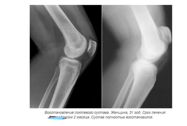 Arms or an error in advertising - Advertising, Longpost, X-ray, Error