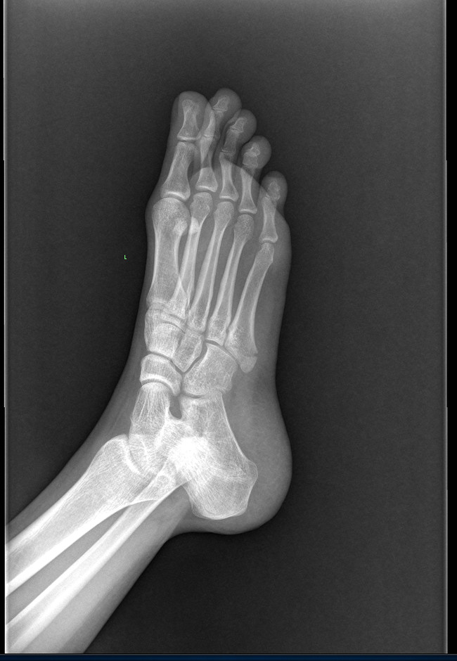 Переломы пальцев стопы и плюсневых костей