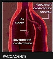 Один из трех, это статистика или пара слов об аневризме - Моё, Аневризма, Аневризма аорты, Медицина, Научпоп, Здоровье, Следизасобой крылышкоможетубит, Длиннопост