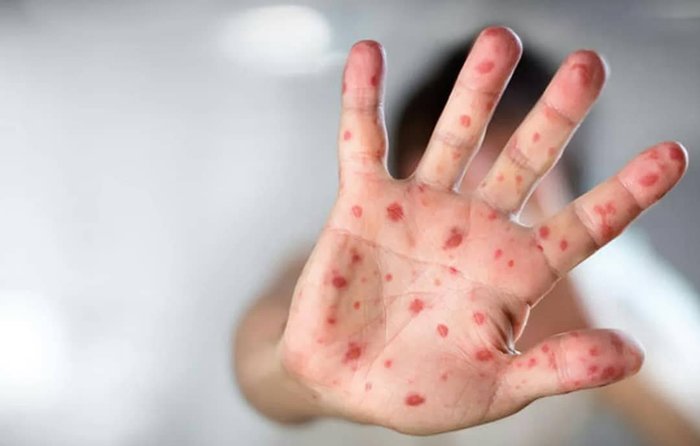 In Dubna, nine lyceum students fell ill with measles - Graft, Measles, Epidemic, Vaccination