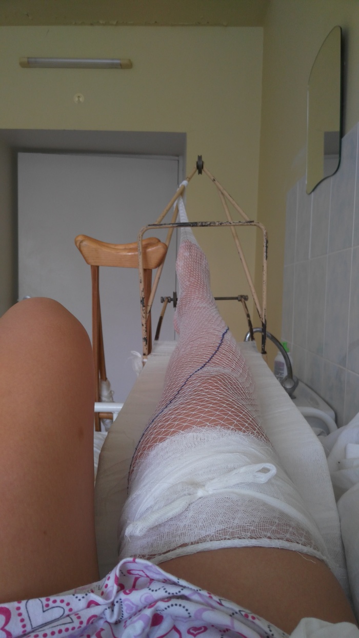 Caution ice or fall, too, must be able to! - My, Osteosynthesis, Broken leg, Operation, Rehabilitation, Longpost