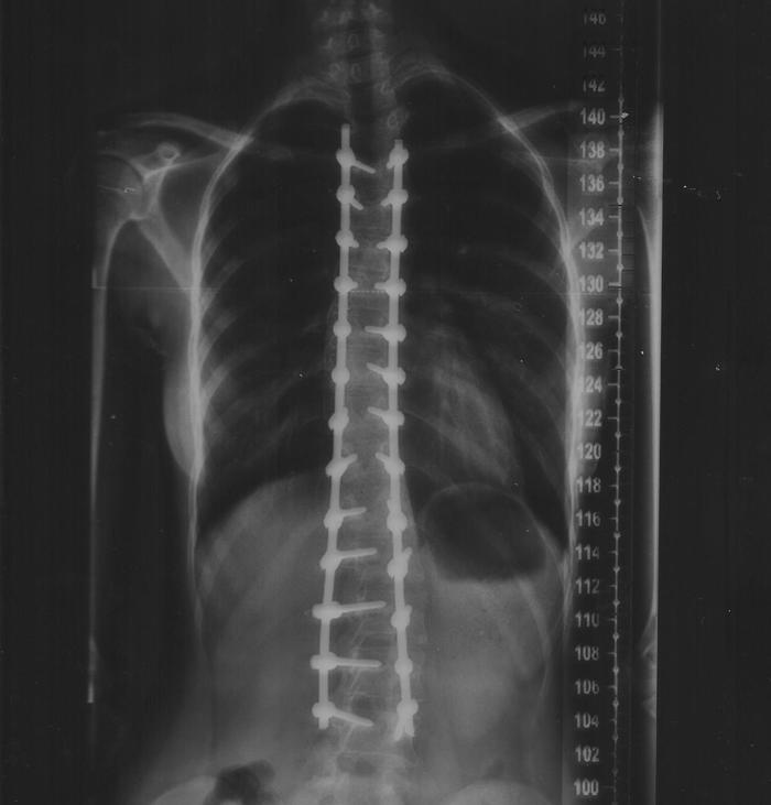 Surgery to correct scoliosis in the Smolensk Federal Center-continued - My, Scoliosis, Correction, Longpost, Orthopedics, The medicine
