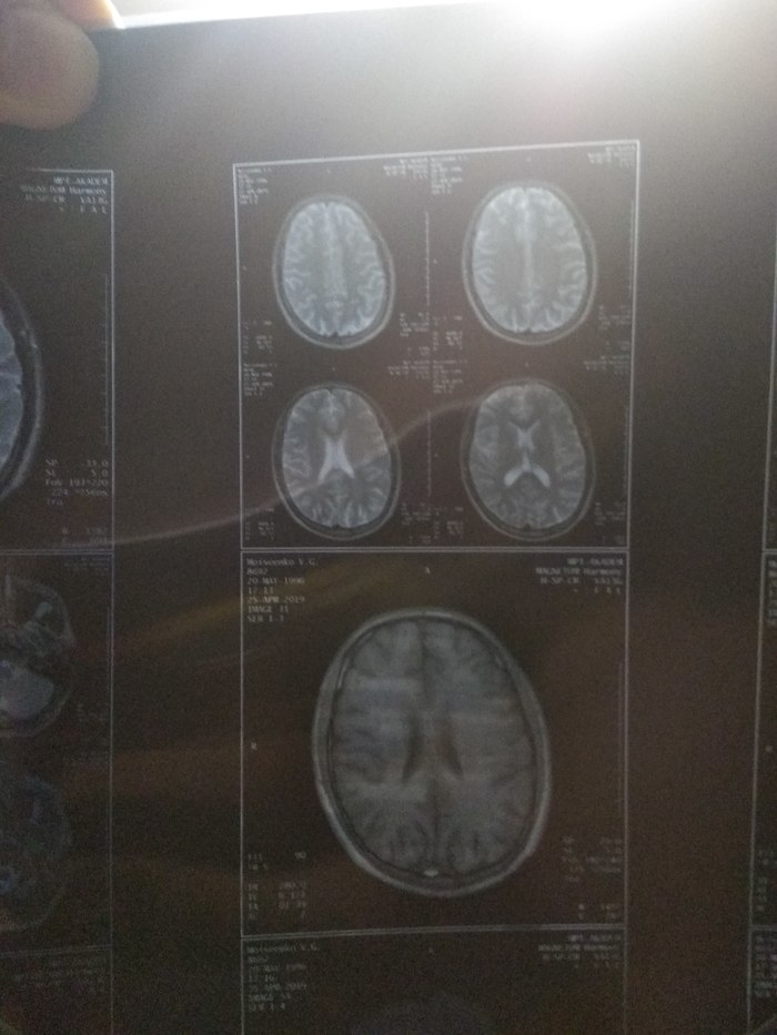MRI of the brain. Cyst - My, Cyst, MRI, Doctors, Neurosurgery, The medicine, Longpost