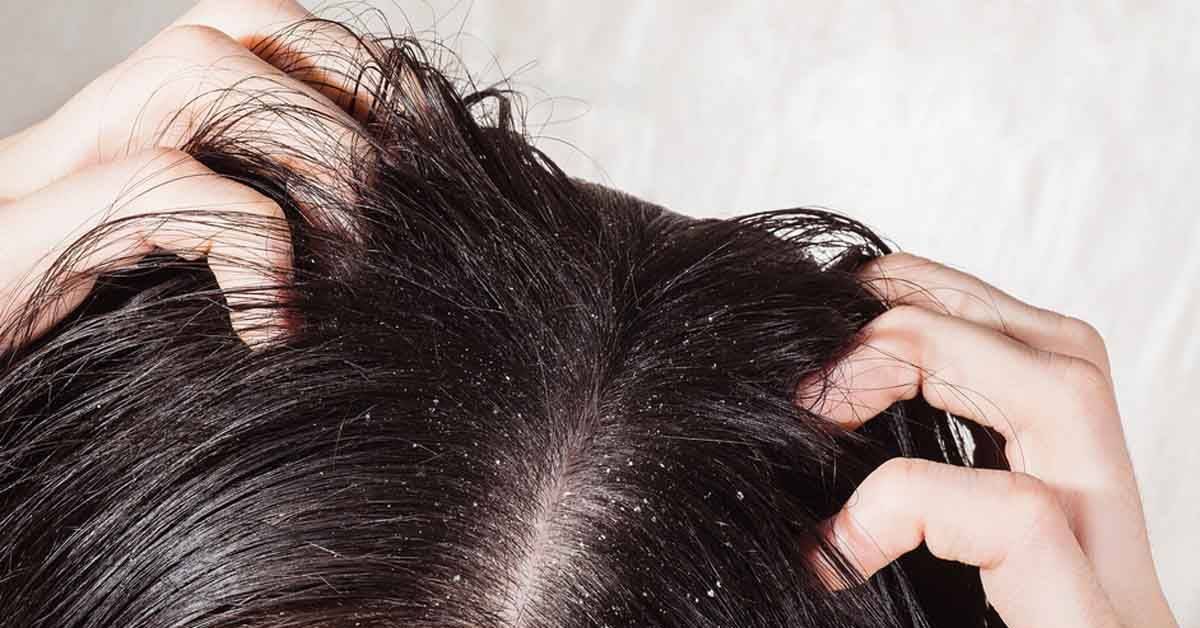 Как лечить жирные волосы и себорею