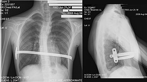 Funnel chest deformity - The medicine, Treatment, Longpost