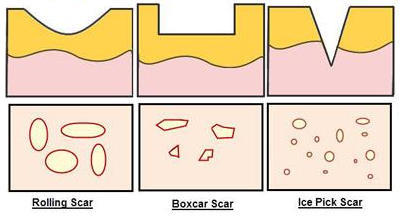 Alternative scar correction - Alternative, Cosmetology, New, Longpost