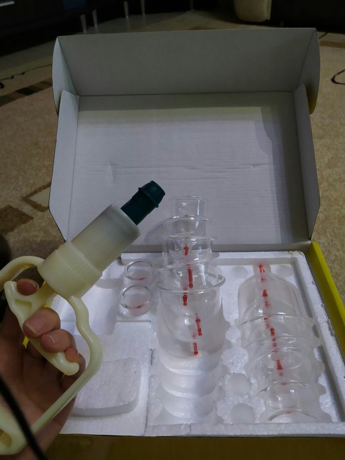 Bloodletting or Muslim hijama - My, Bloodletting, Hijama, Blood, Longpost, Alternative medicine