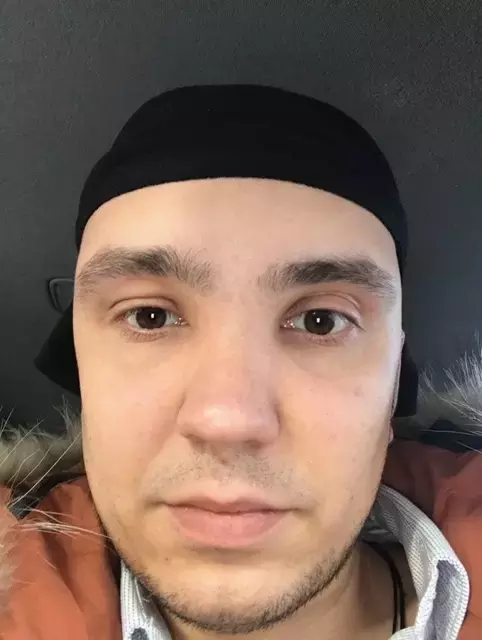 ÐеÑеÑадка Ð²Ð¾Ð»Ð¾Ñ Ð¼ÐµÑодом FUE в ТÑÑÑии ÐеÑеÑадка волоÑ, ÐблÑÑение, ÐлиннопоÑÑ