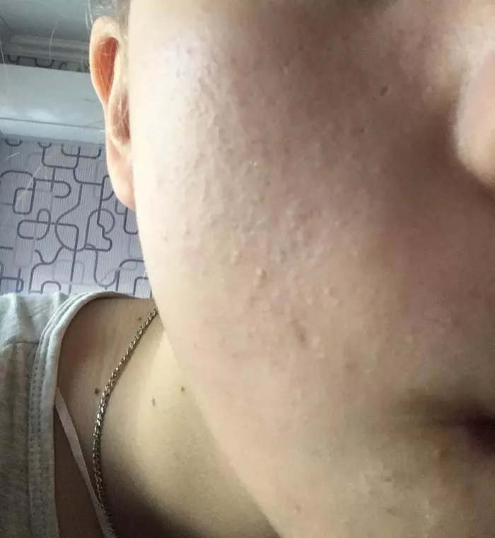 Cry for help with skin - My, Problem skin, Acne, Comedones, Personal care, Help, , Longpost