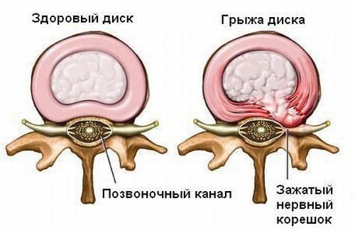 C5/C6 herniated disc (my story) - My, Disease, Intervertebral hernia, Cervical osteochondrosis, Video, Longpost