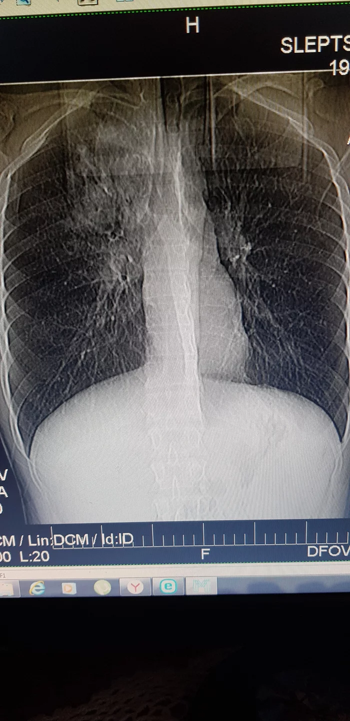 Help me decipher a lung CT scan - My, Free medicine, Discussion