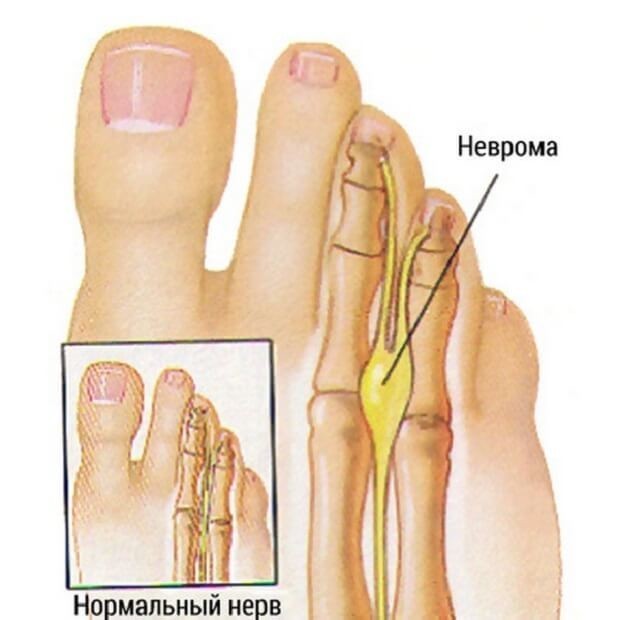 Morton's neuroma - My, The medicine, Germany, Doctors