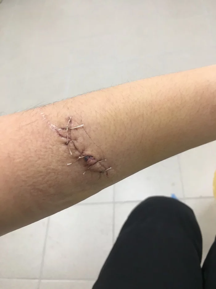 Deep cut. LEVOMEKOL? - My, Wound, Seams, A cut, Ointment, Levomekol, Doctors, Medics, Help