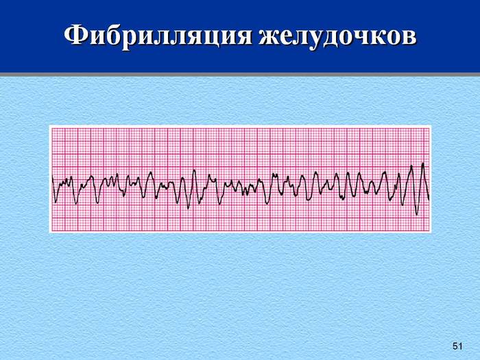 Fibrillation and defibrillation - Defibrillator, ECG, Death, Longpost