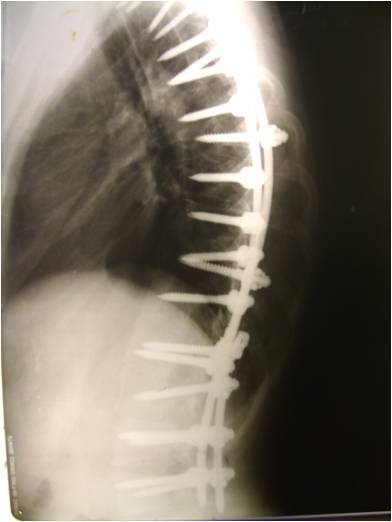 Scoliosis. Enlightenment fast - My, Scoliosis, Curvature of the spine, Kyphosis, Longpost