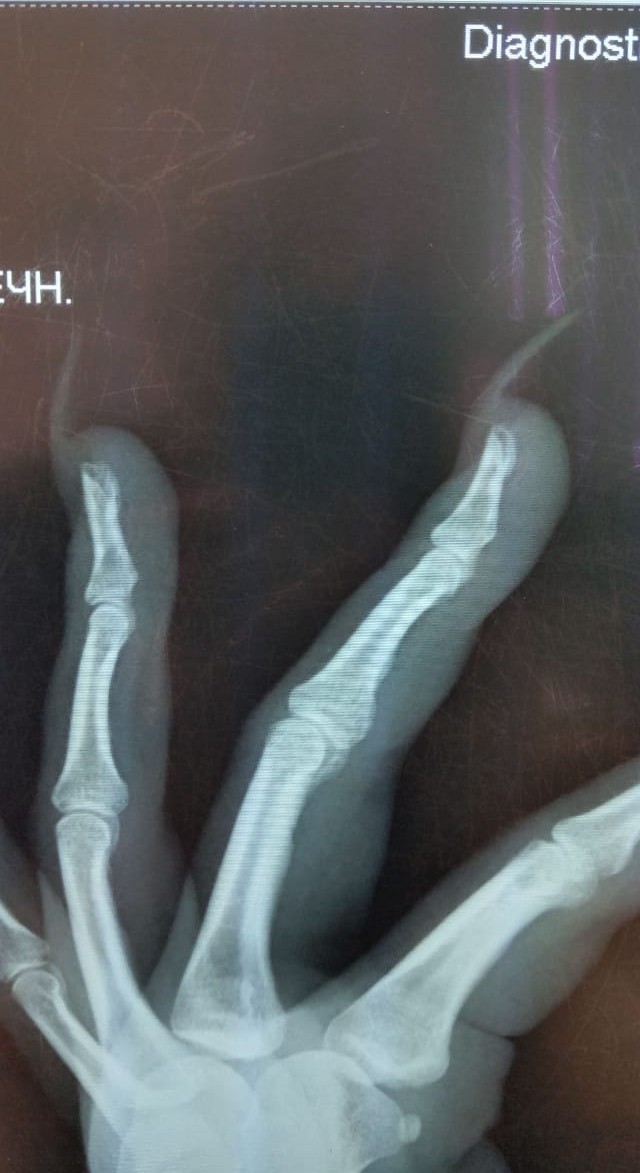 Marigold - Nails, X-ray