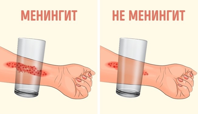 Менингит - Моё, Менингит, Медицина, Длиннопост