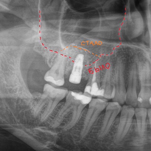 Recommendations after visiting a dental surgeon - My, Dentist, Dentistry, Surgeon, Surgery, Recommendations, Doctors, Teeth, The medicine, Mat, Longpost