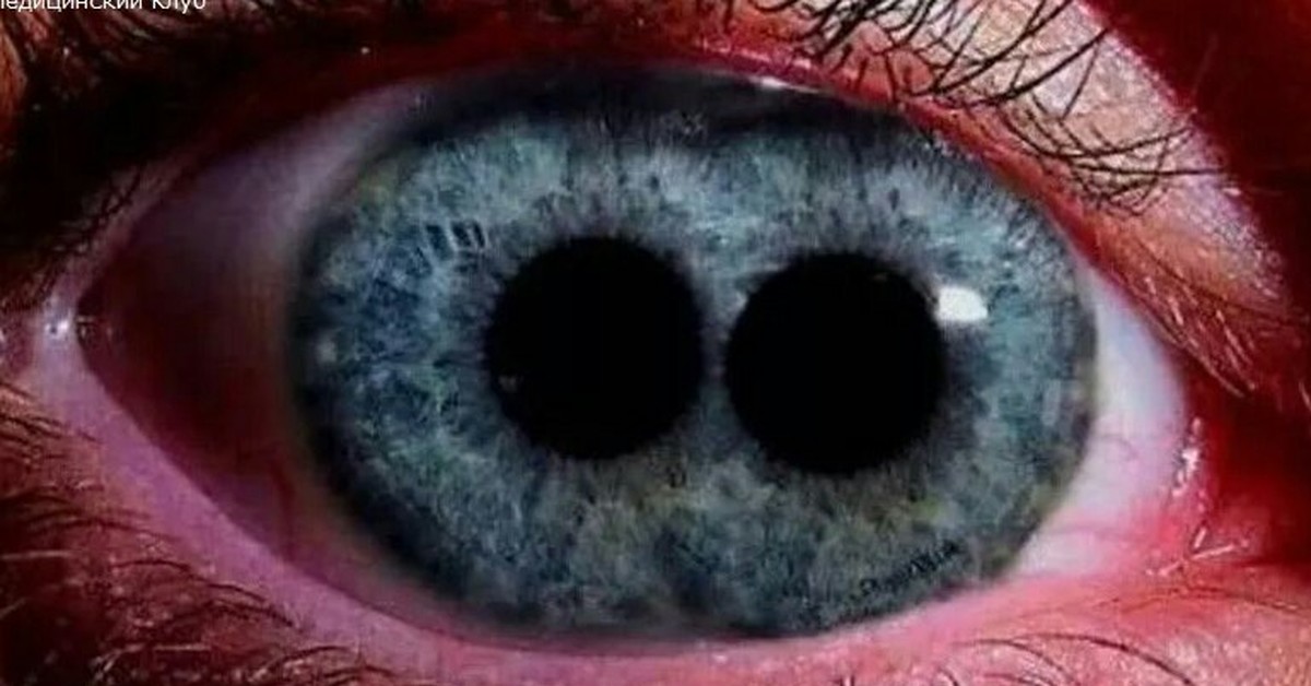 Болезни радужки. PUPULA Duplex двойной зрачок. Поликория аномалия глаз.
