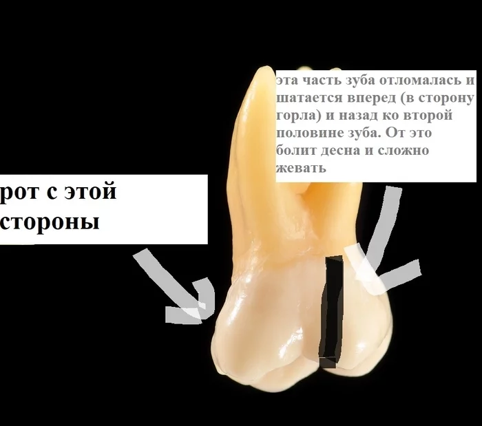 Лига стоматологов, спасите! как самому себе лечить зуб на карантине? - Моё, Коронавирус, Стоматология, Спасите