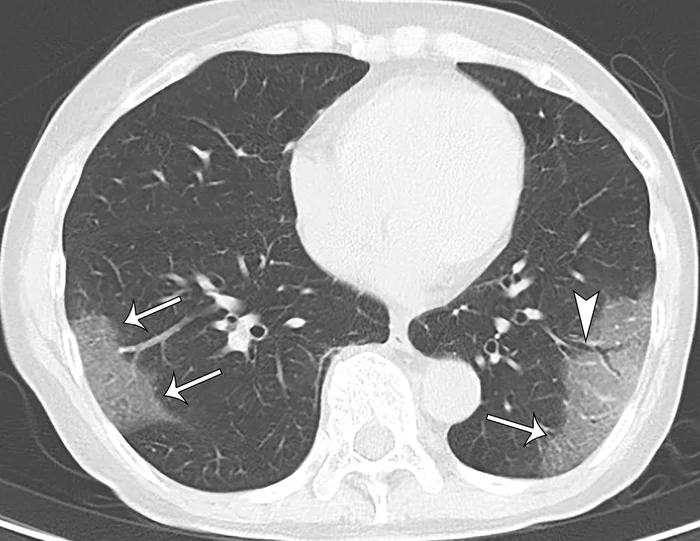 Lung lesions found in asymptomatic COVID-19 patients - Coronavirus, Lungs, Health, Consequences, Research, The medicine, CT, Information, Longpost