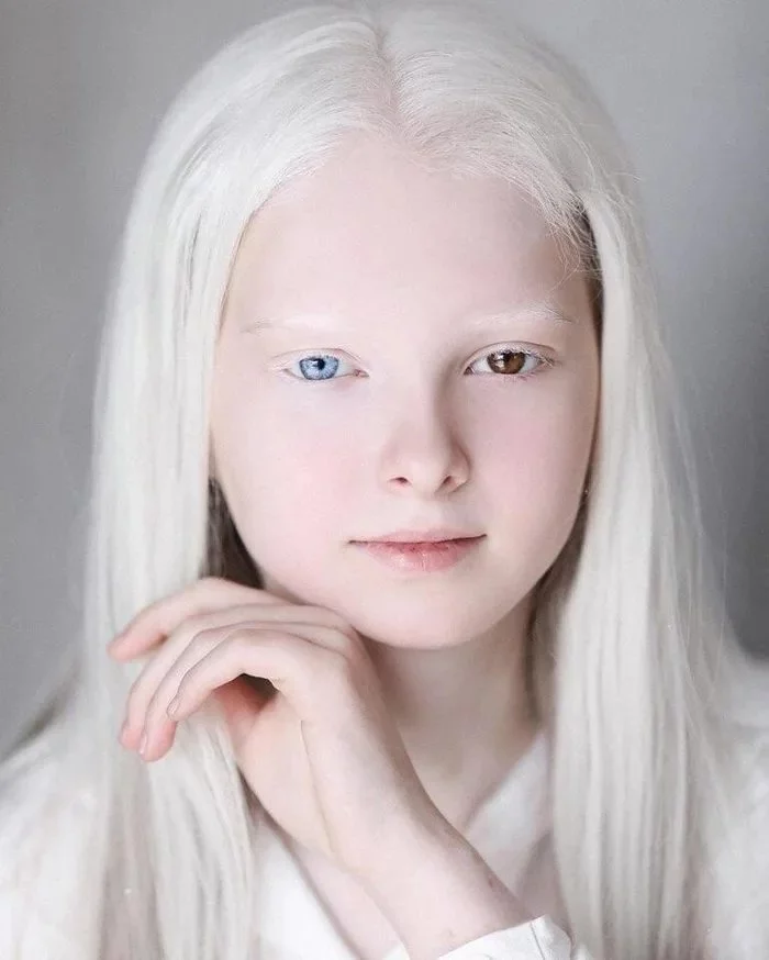 Heterochromia and albinism - Heterochromia, Albino, Girl