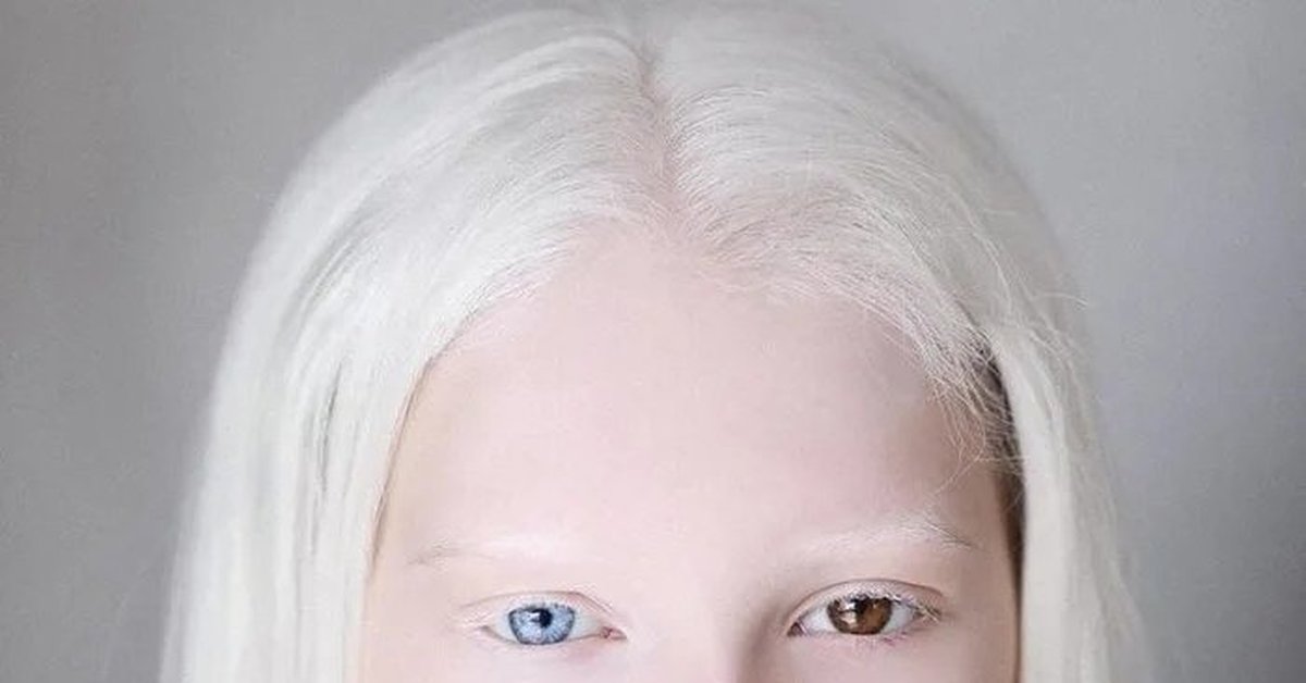 Альбинизмом страдают. Глазно-кожный альбинизм. Глазокожный альбинизм 4 типа. Глазокожный альбинизм Тип 2.