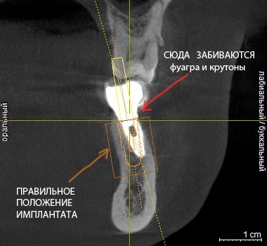 Dentistry: expectation and reality - My, Dentist, Dentistry, Surgeon, Doctors, Teeth, Dental implantation, The medicine, Doctor, Longpost