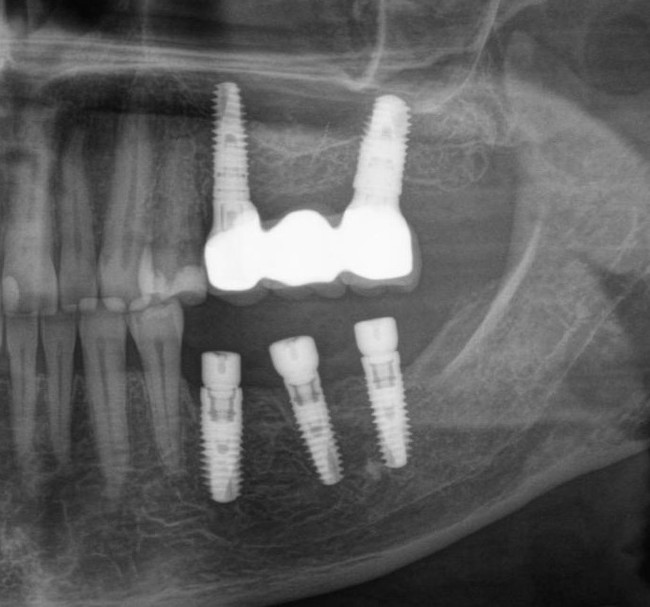 Dentistry: expectation and reality - My, Dentist, Dentistry, Surgeon, Doctors, Teeth, Dental implantation, The medicine, Doctor, Longpost