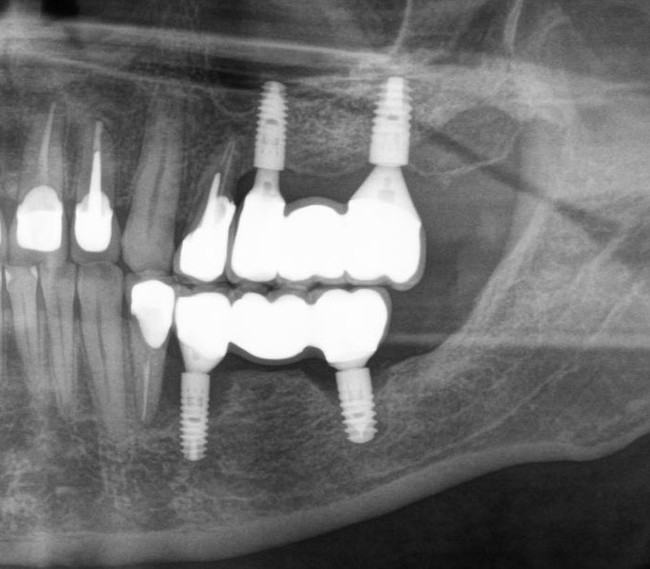 Dentistry: expectation and reality - My, Dentist, Dentistry, Surgeon, Doctors, Teeth, Dental implantation, The medicine, Doctor, Longpost