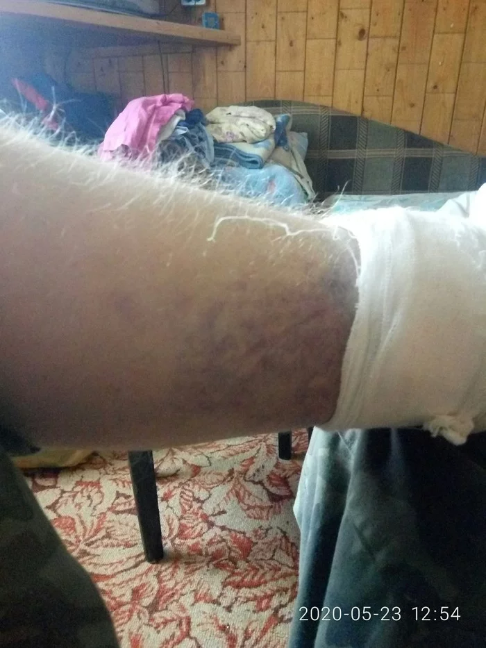 Need advice on ankle sprain (photo) - My, Dislocation, Sprain, Help, Medical certificate, Ankle