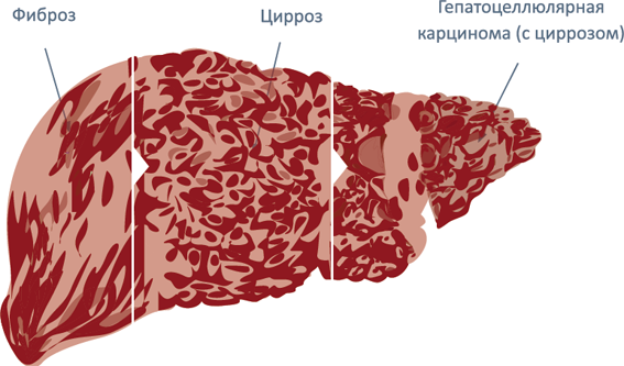 The best treatment regimen for hepatitis C - My, Hepatitis C, Hepatitis B, Hepatitis A, Cirrhosis, Fibrosis, Sofosbuvir