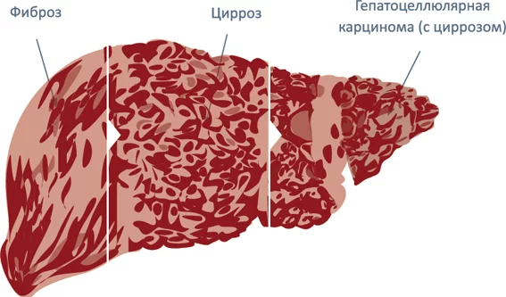 Лучшая схема лечения гепатита С - Моё, Гепатит C, Гепатит B, Гепатит А, Цирроз, Фиброз, Софосбувир