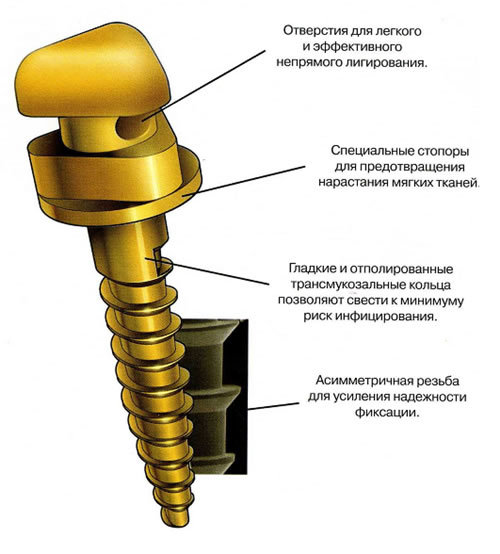 Как работают брекеты? | Пикабу