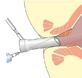 Hemorrhoids - surgical treatment. Part 1 - My, The medicine, Proctologist, Haemorrhoids, Longpost