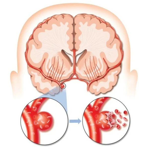 Notes of a stroke patient. Survived a stroke at 46 years old - My, Stroke, Hemorrhagic stroke, Blood vessels, Health, Blog, Longpost