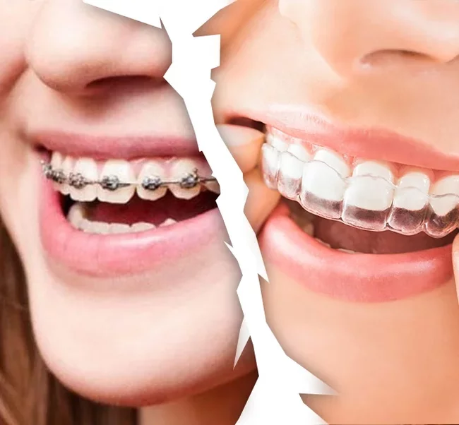 Post #7538692 - My, Braces, Dentistry, Orthodontics, Aligners, Orthodontist