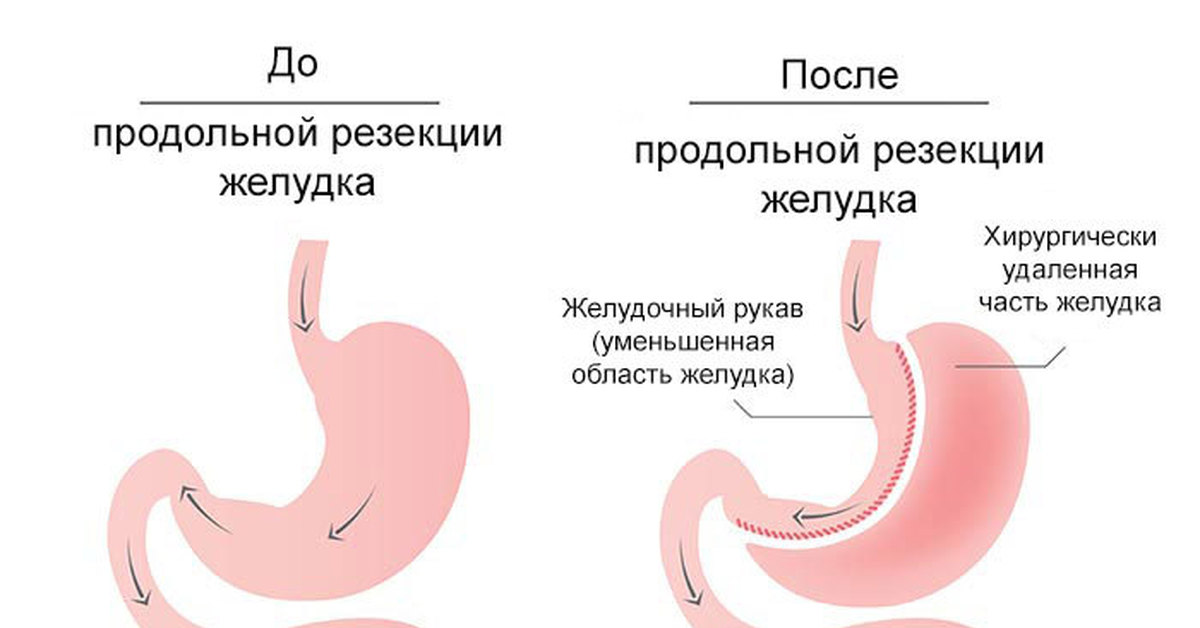 После удаления части желудка. Бариатрическая продольная резекция желудка. Продольная (рукавная) резекция желудка. Калибровочный зонд для продольной резекции желудка.