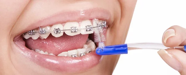 How to protect teeth with braces? - My, Dentistry, The medicine, beauty, Health, Teeth, Braces, Hygiene, Oral hygiene, Longpost