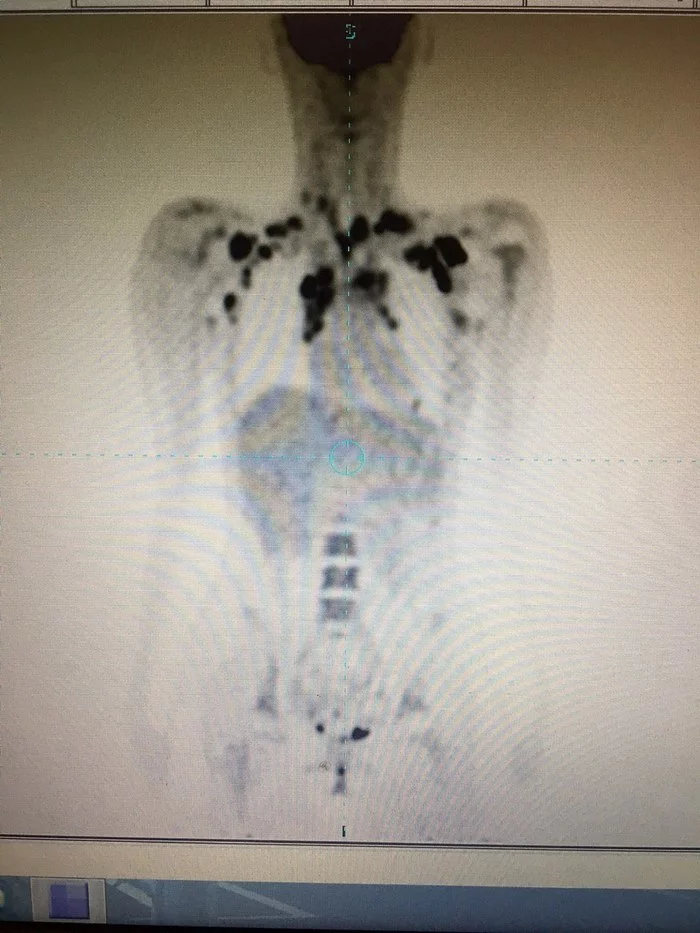 Hodgkin's lymphoma. Post 5, intermediate - My, Hodgkin's lymphoma, Side effect, Chemotherapy, Longpost