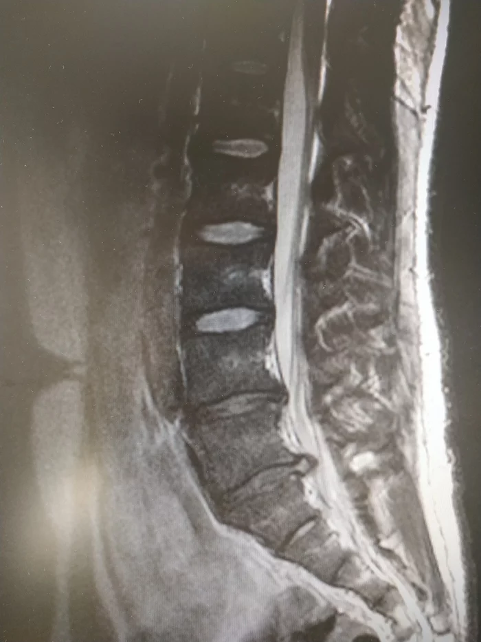 Intervertebral hernia. L5S1 treatment. I'm asking for advice - My, Intervertebral hernia, Hernia, Neurology, The medicine, Treatment, Back, Pain, Doctors, Longpost