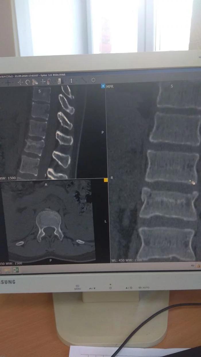 Compression fracture of the spine l1 - need help and advice 2 - My, Fracture of the spine, Neurosurgery, Injury, Traumatology, Loin, Hospital, Longpost