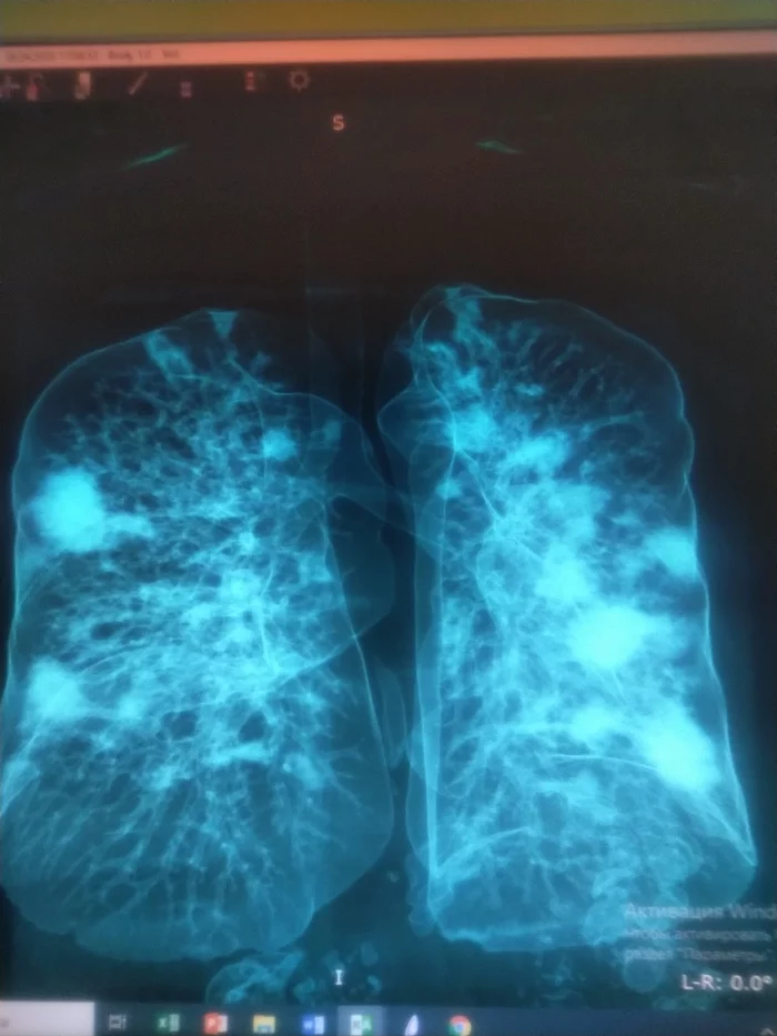 Lungs affected by Covid - My, Coronavirus, Pneumonia, CT, Lungs, Longpost