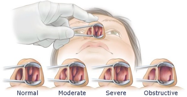 Me and my nose. A quarter of a century before happiness. - My, The medicine, Operation, Xylometazoline, Happiness, Text, My, Many letters, Longpost