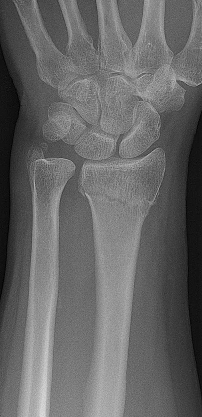 Как определить трещину в кости. Лучевая кость на руке перелом. Перелом лучевой кости сз5. Перелом лучевой кости рентген. Рентген перелома лучевой кости руки.