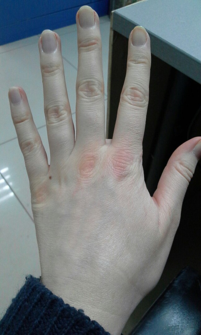 Boxer's fingers. - My, Health, Disease, The medicine, Dermatology, Longpost