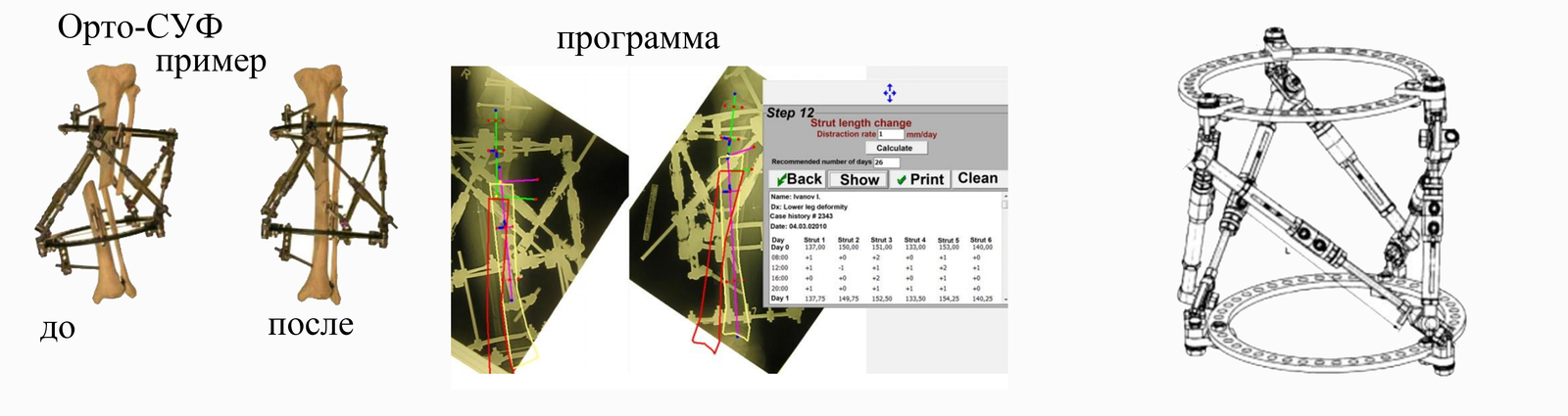 Ilizarov apparatus. My experience - My, Ilizarov apparatus, Experience, Stages, Advice, Hospital, Longpost