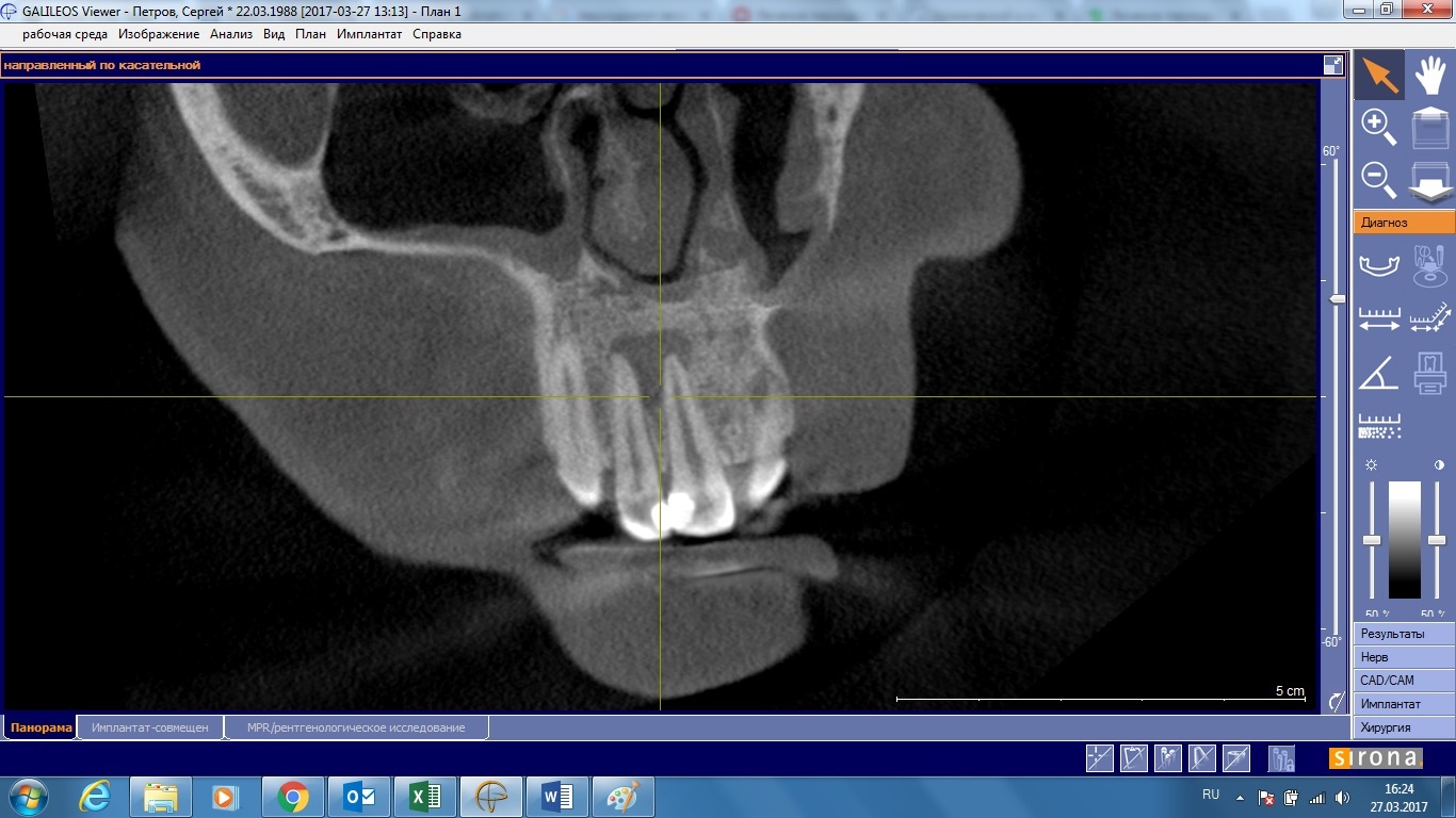 Such teeth are removed or going to the dentist - My, Dentistry, , Teeth, Pain, , Help, The medicine, Doctors