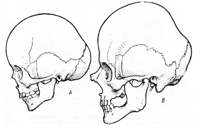 Лоб кость. Естественные и искусственные деформации черепа. Седловидная деформации черепа. Форма черепа человека сбоку. Пороки развития мозгового отдела черепа.